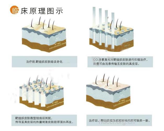 激光除皱有哪些手术原理