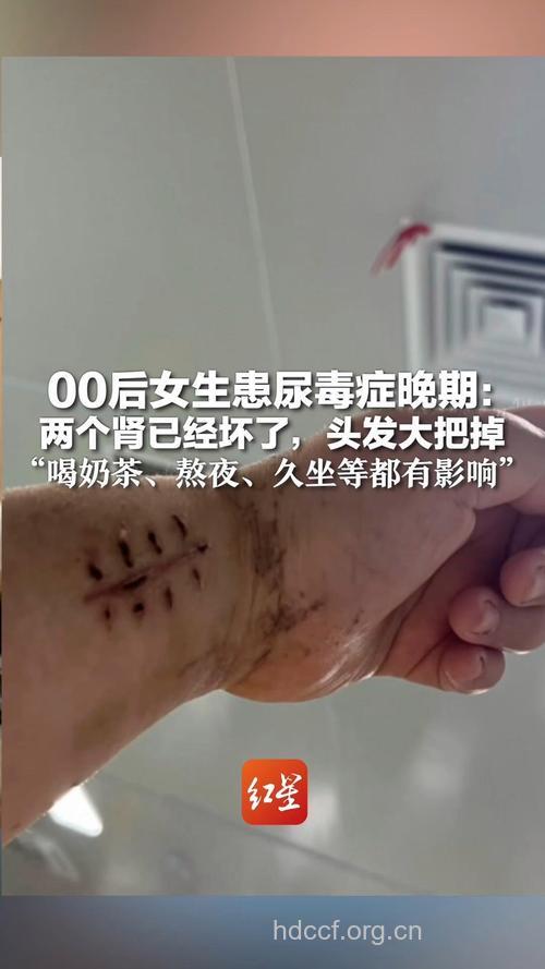 女性尿毒症晚期的8个表现