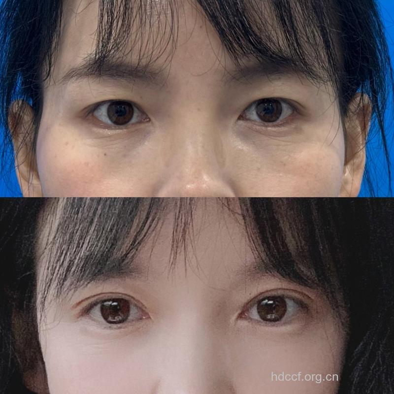 割双眼皮是宽点好还是窄点好?