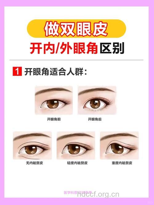 开眼角手术有哪些特点