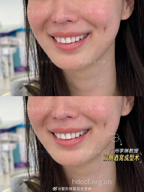 酒窝再造术后的护理