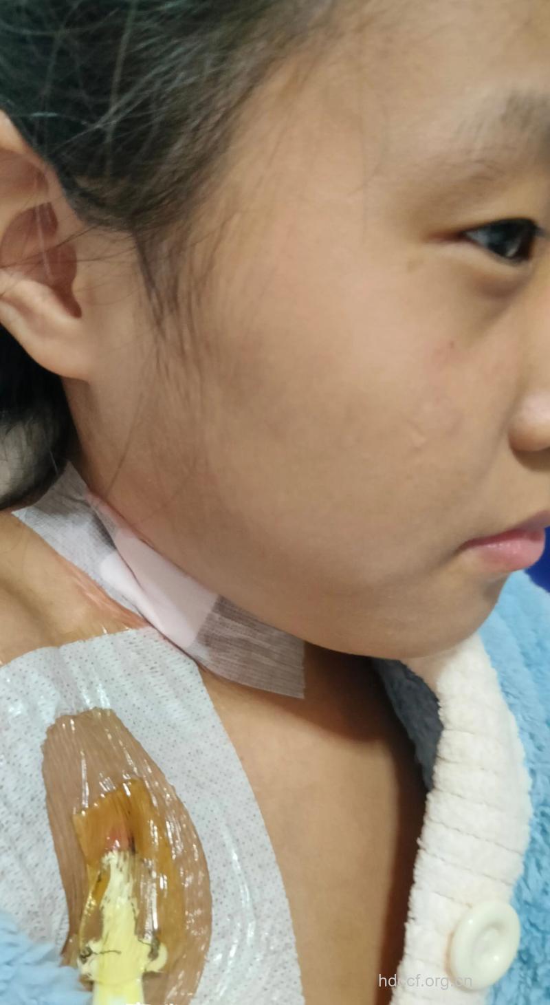 女性尿毒症晚期有什么特点