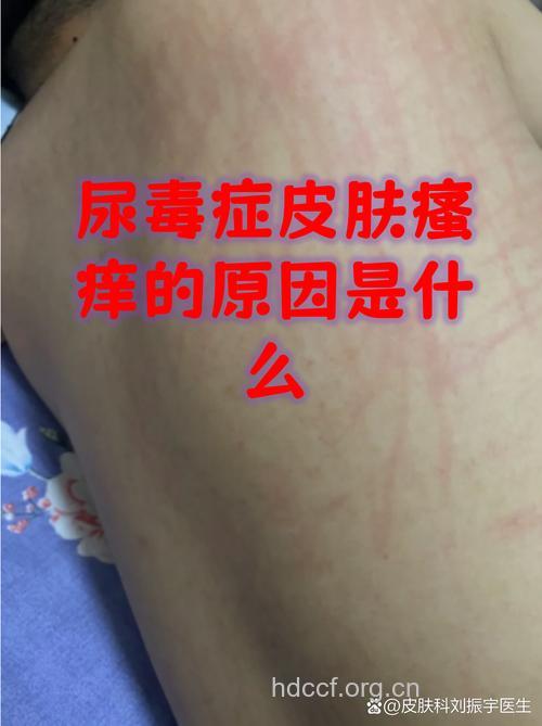 尿毒症皮肤瘙痒怎么办？