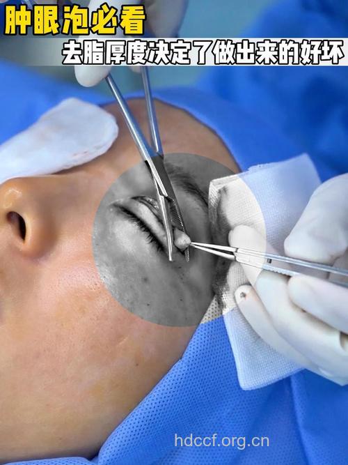 怎么进行微创面部吸脂手术方法