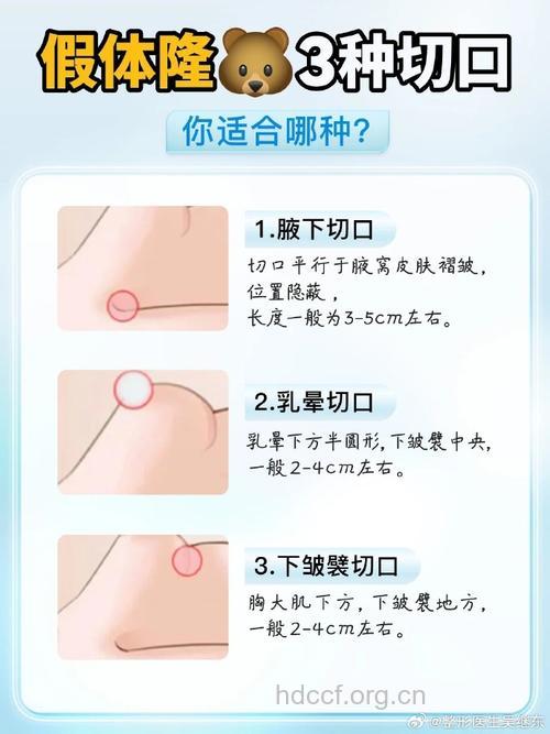 隆胸手术可以分为哪三种