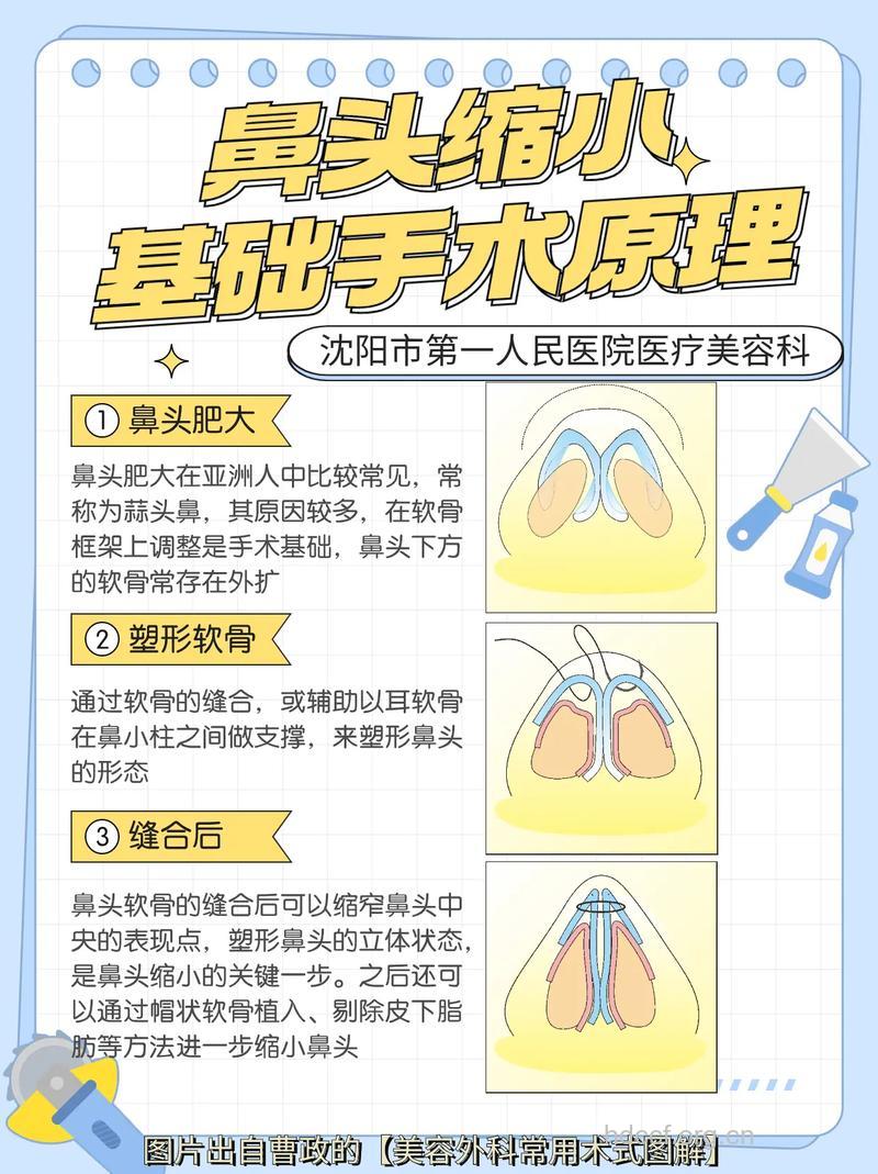 怎么进行鼻头缩小手术方法