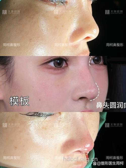 怎么看待假体隆鼻的手术效果