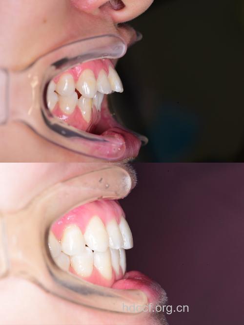 最常见的牙齿整形方式