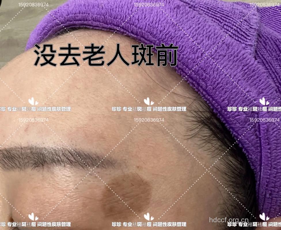 怎么手术祛除手术老年斑方法