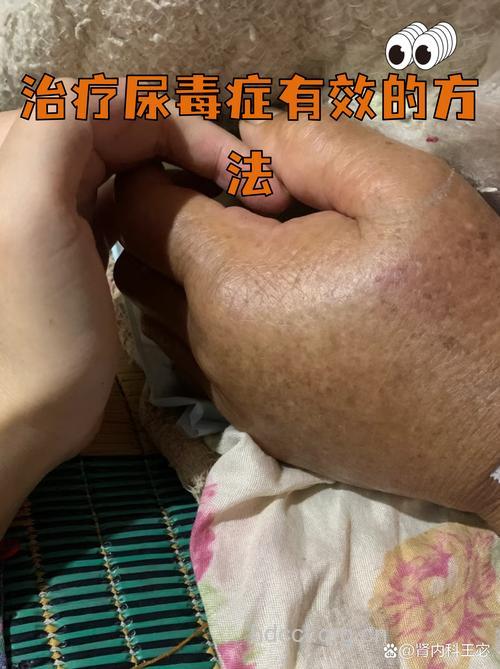 尿毒症者的燃眉之急是什么