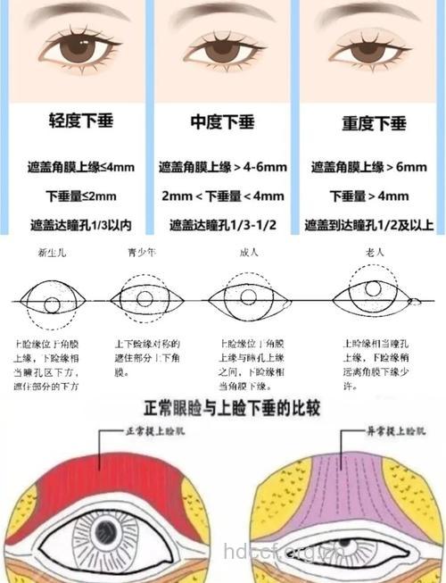 上睑下垂矫正有哪些手术原则