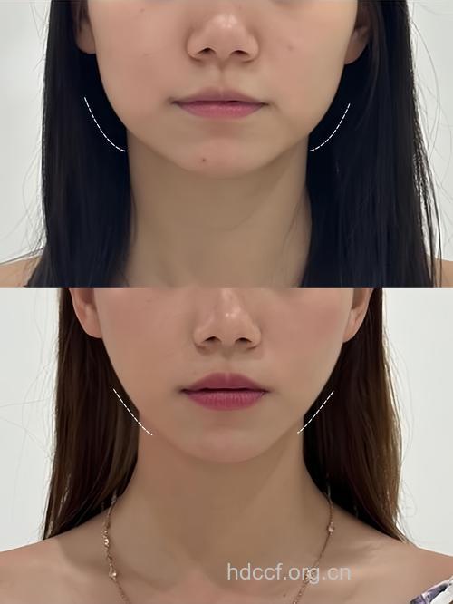 下颌角整形成就小脸美女