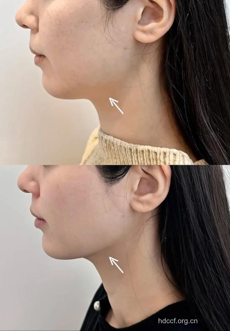 你适合“下颌角整形”吗