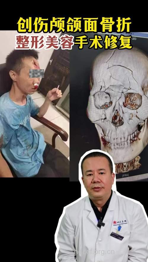 颅颌面整形美容手术