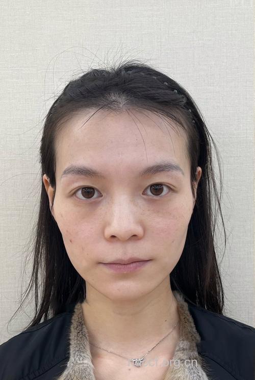 苹果肌丰颊手术