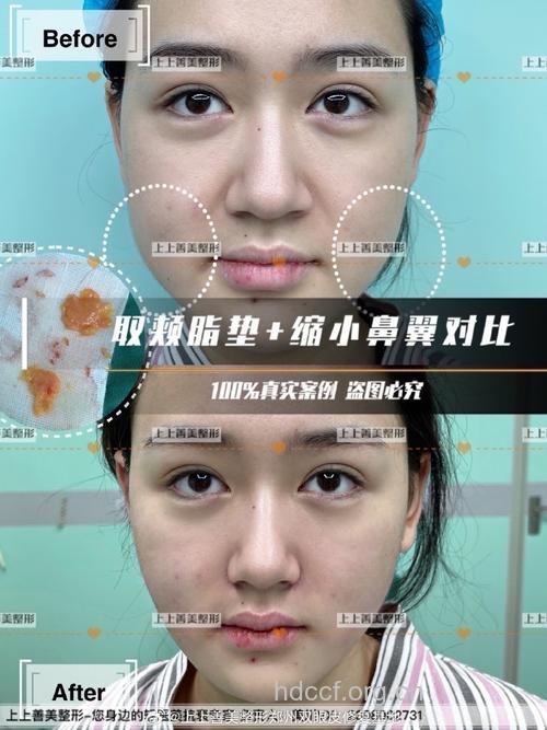 面部吸脂术和颊脂垫切除术