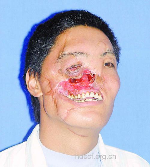 首例面部整体换脸成功