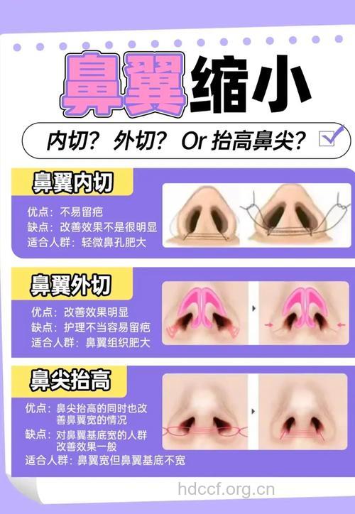 鼻翼缩小有哪些常见手术方法