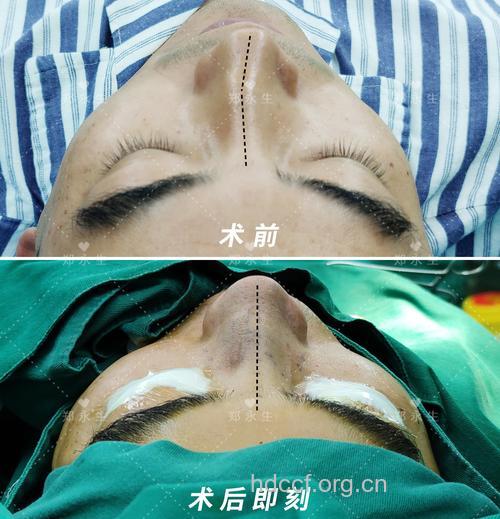 歪鼻有哪些矫正手术方法