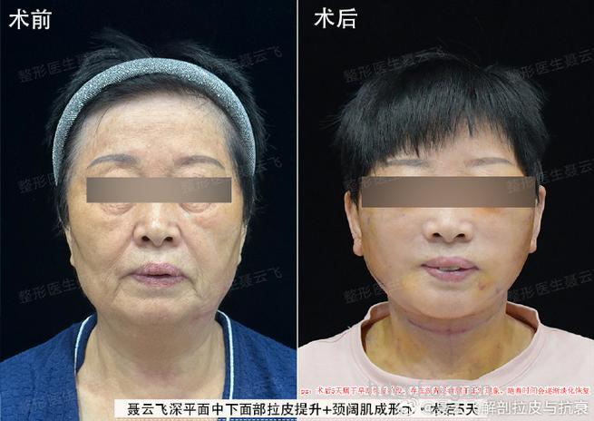 中年女人怎么做电波拉皮手术