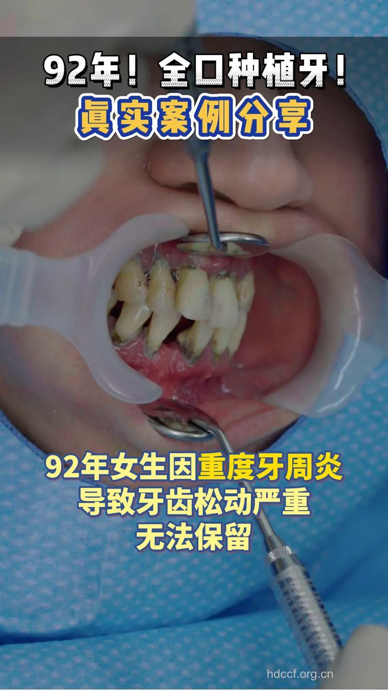 牙周炎患者能植牙手术吗