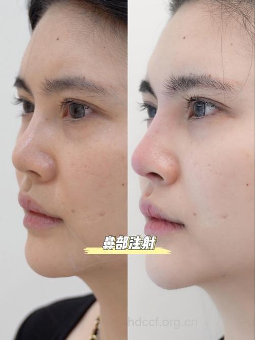 注射隆鼻有哪些手术特点