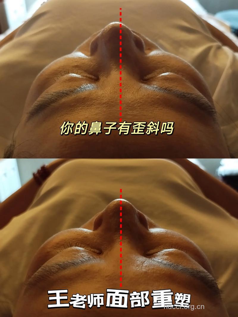 鼻子歪有哪些矫正方法