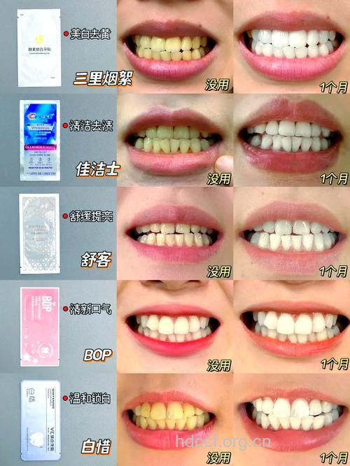 牙齿美容有哪些标准