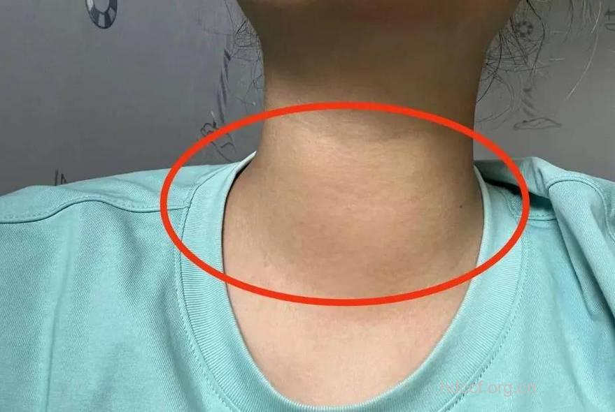 疾病百科 甲状腺肿大是什么样子的
