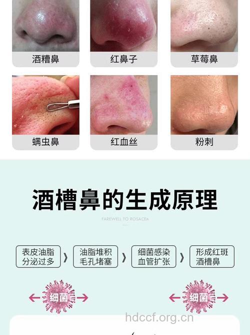 怎样治疗酒糟鼻