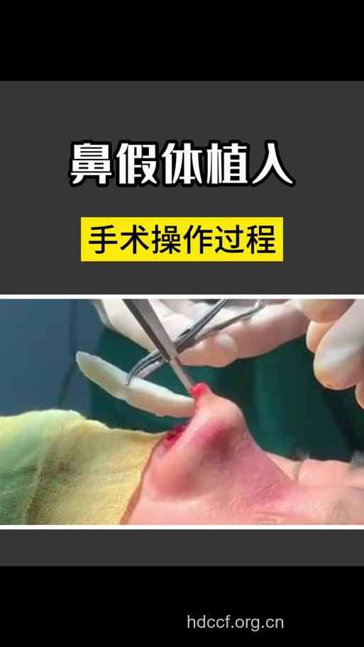 隆鼻手术中假体植入要放在哪