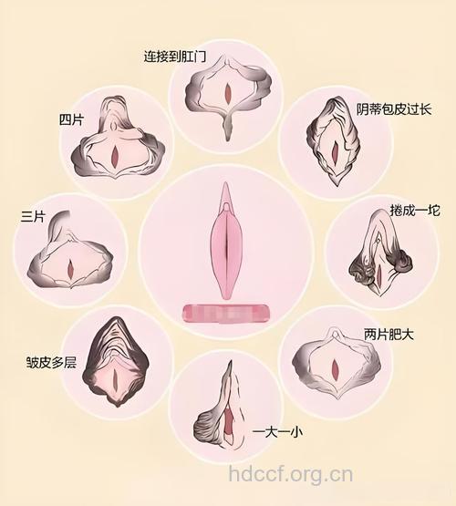 常见的女性阴道整形有哪些