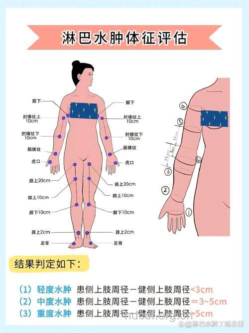 下肢淋巴水肿如何自我鉴别