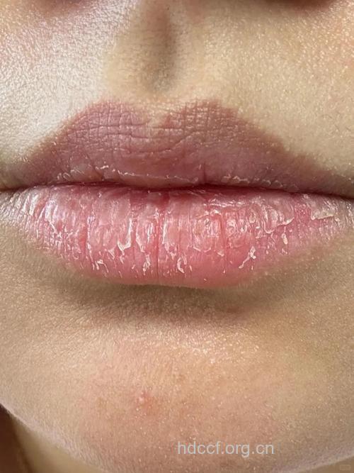 口唇干裂您还具魅力吗?