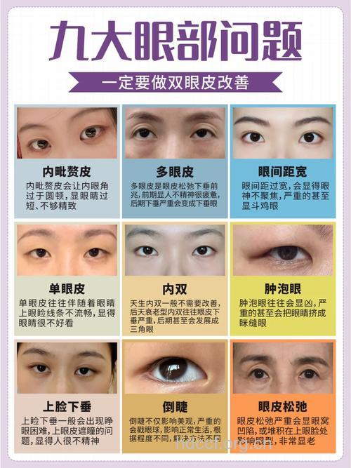 眼部整形有哪些常见问题