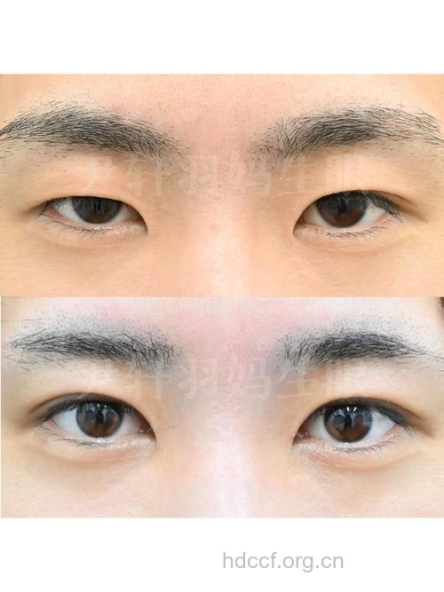 男士有哪些眼部整形方法
