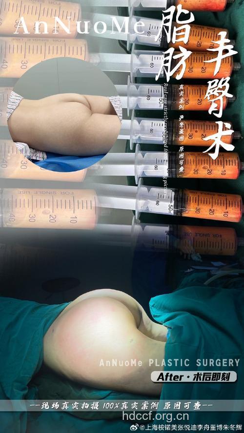 常见的丰臀术有哪些