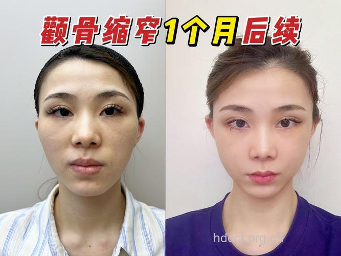 颧骨整形有哪些手术方法