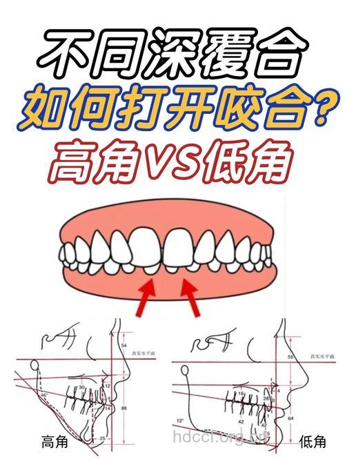 纠正牙齿咬合不正的方法