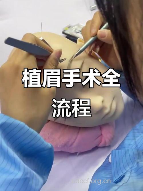 什么是植眉手术方法