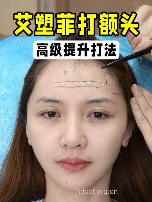 怎么进行额部填充手术方法