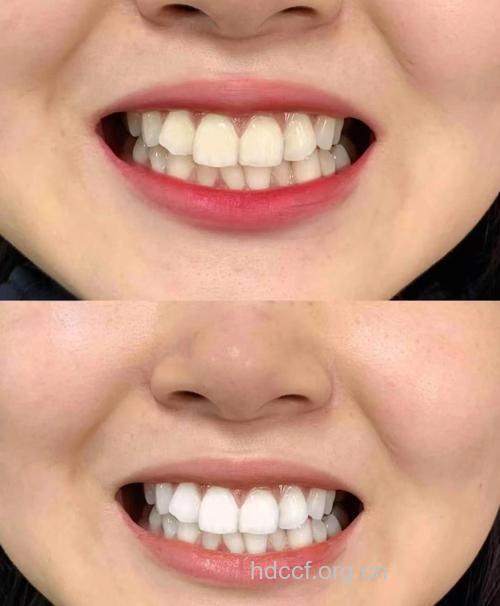 生态牙美白，恢复牙齿洁白与健康