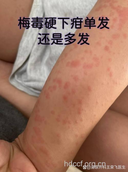 一颗杨梅核引起的三种不适症状