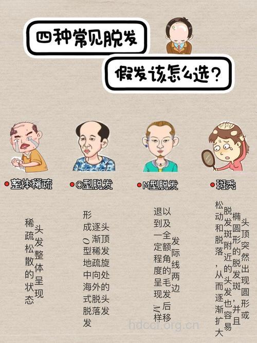 哪些男人更容易脱发