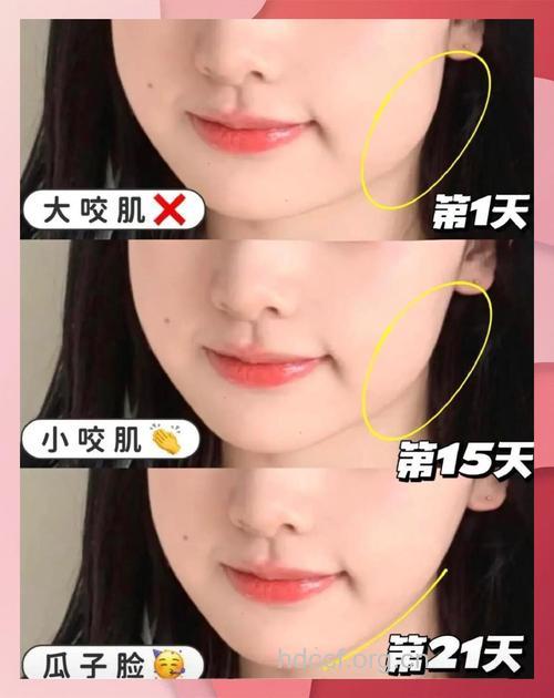 怎么快速祛除咬肌肥大方法