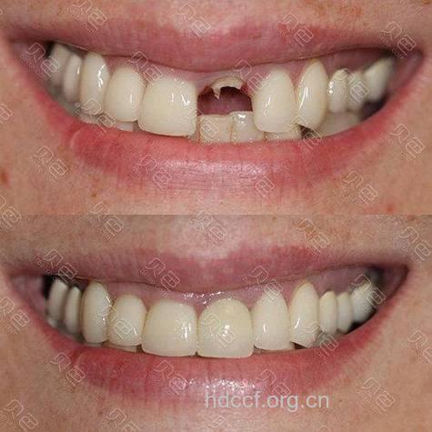 种植完成后牙齿感觉跟天然牙一样