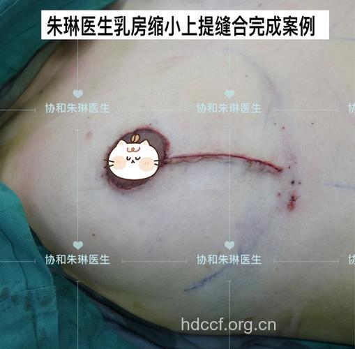 什么是乳房重建手术