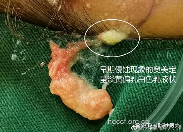 奥美定可能会诱发乳腺癌