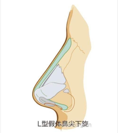 硅胶隆鼻的缺点有哪些
