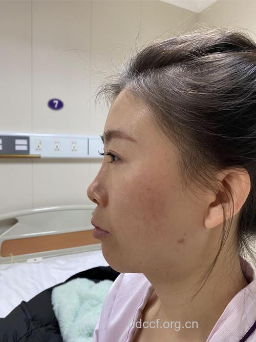 硅胶隆鼻能保持多久